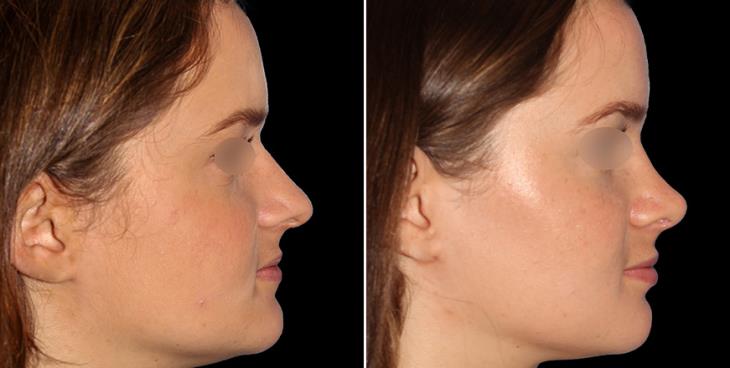 Right Side View Rhinoplasty Results