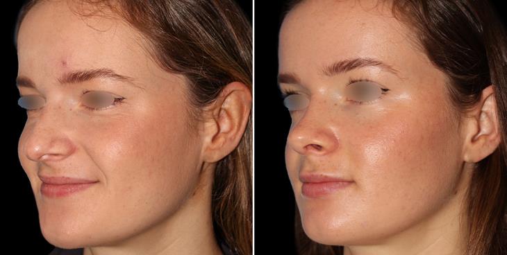Nose Surgery Before & After Marietta GA