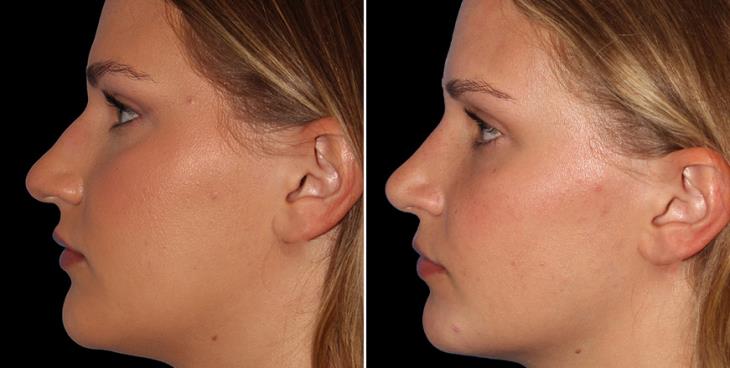 Results Of Rhinoplasty Surgery Marietta Georgia