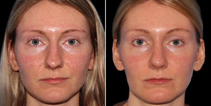 Before & After Rhinoplasty Marietta Georgia