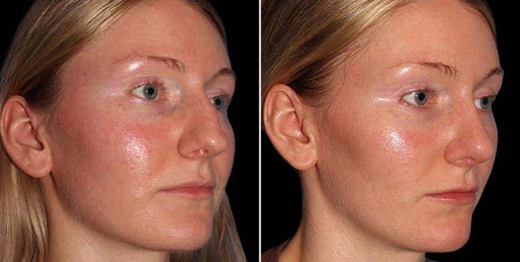 Before And After Rhinoplasty Marietta Georgia