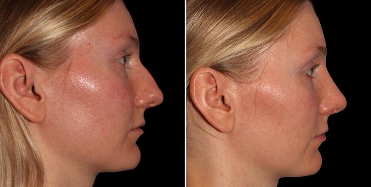 Rhinoplasty Before & After Marietta Georgia