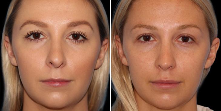 Rhinoplasty Before And After Marietta Georgia