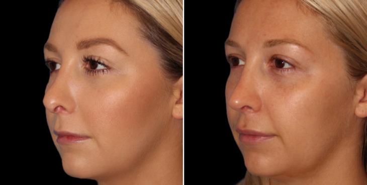 Before & After Rhinoplasty Surgery Marietta Georgia