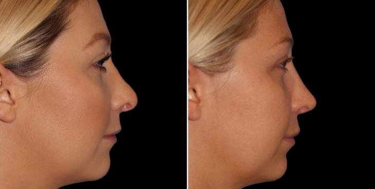 Before And After Rhinoplasty Surgery Marietta Georgia