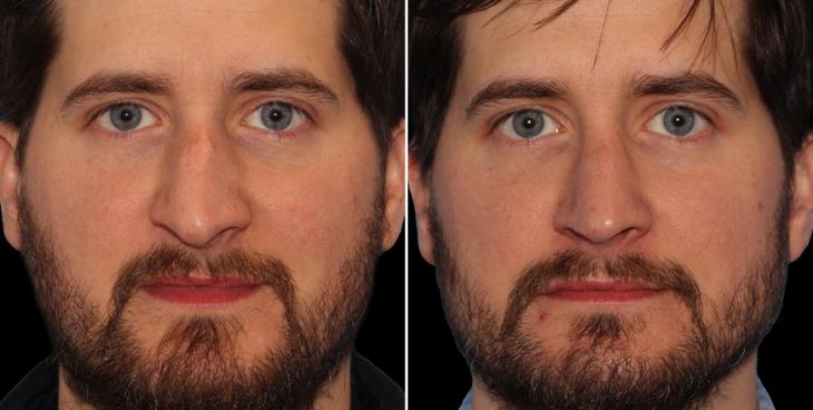 Before & After Nose Surgery Marietta Georgia