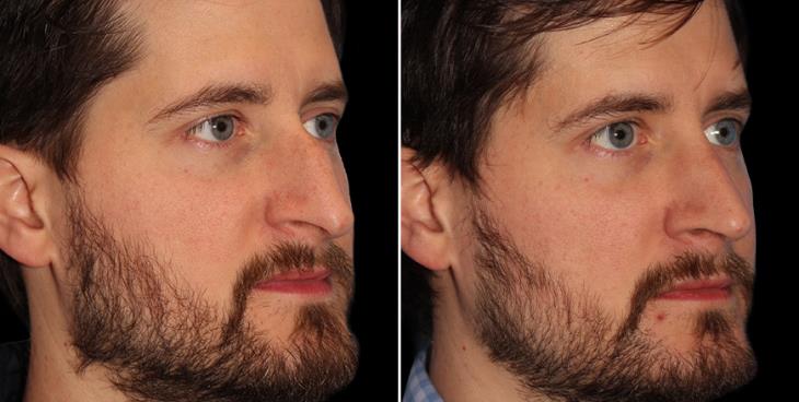 Nose Surgery Before & After Marietta Georgia
