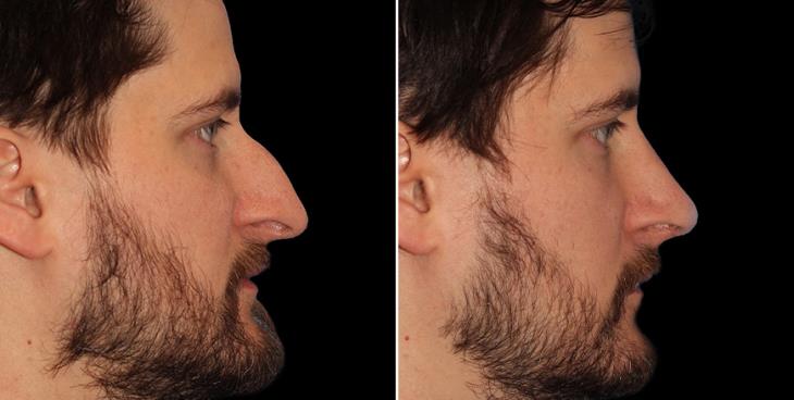 Rhinoplasty Results Alpharetta