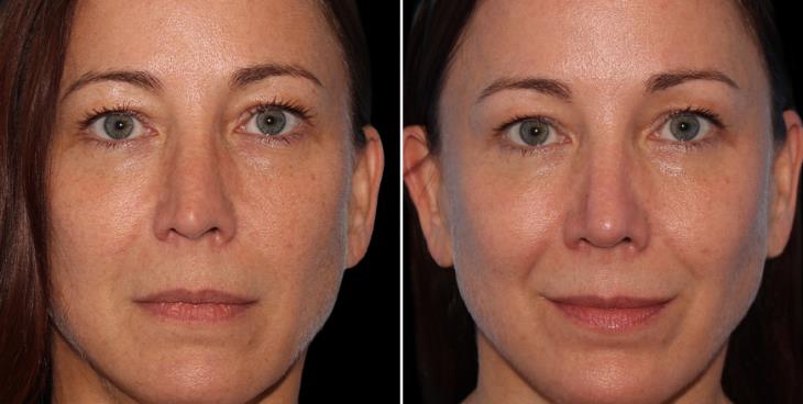 Results Of Rhinoplasty Alpharetta