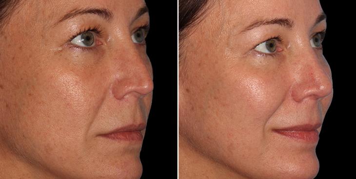 Rhinoplasty Surgery Results Alpharetta