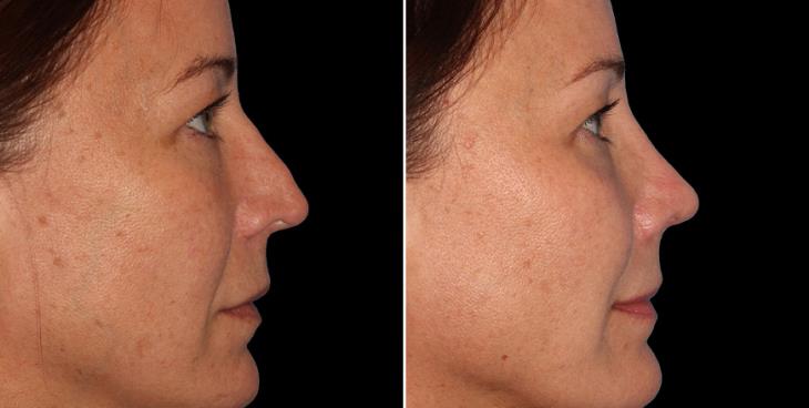 Results Of Rhinoplasty Surgery Alpharetta