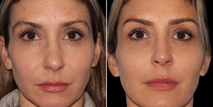 Before & After Rhinoplasty Alpharetta