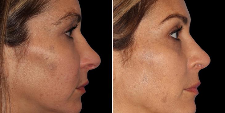 Rhinoplasty Before & After Alpharetta