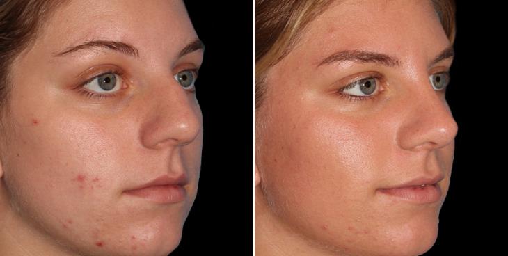 Before & After Rhinoplasty Surgery Alpharetta