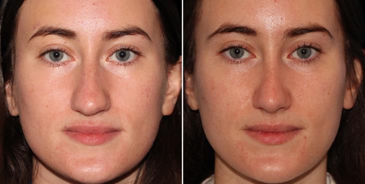 Rhinoplasty Surgery Before & After Alpharetta