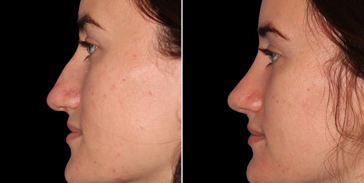 Nose Surgery Results Alpharetta