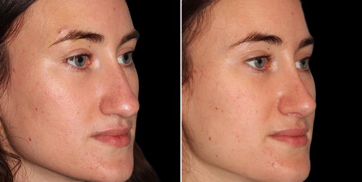 Before And After Nose Surgery Alpharetta