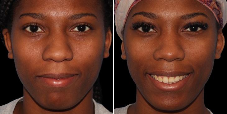 Nose Surgery Before And After Alpharetta
