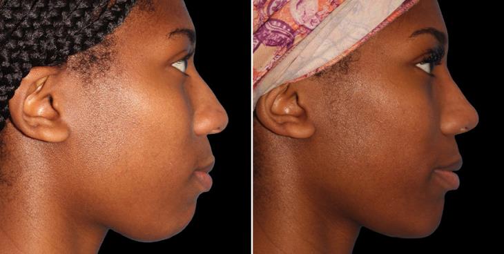 Rhinoplasty Results Alpharetta GA