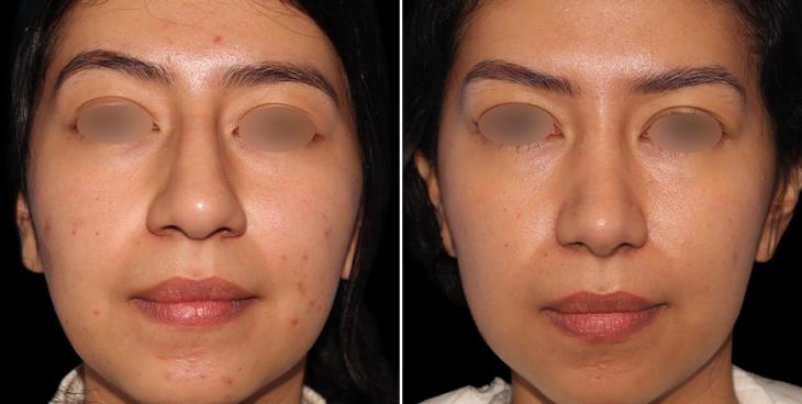 Results Of Rhinoplasty Alpharetta GA