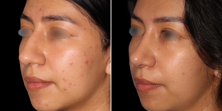 Rhinoplasty Surgery Results Alpharetta GA