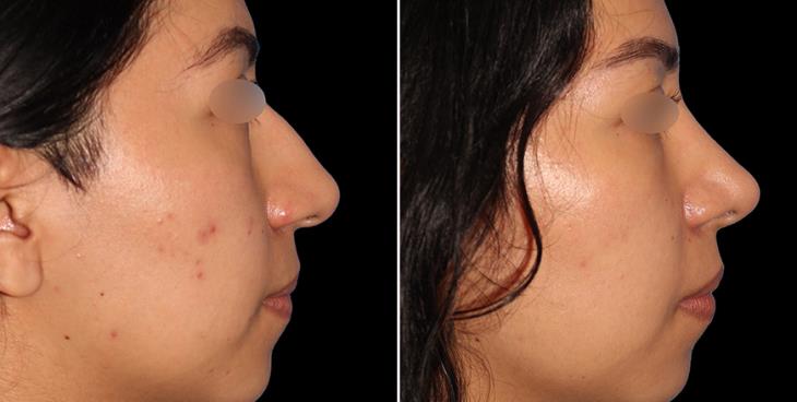 Results Of Rhinoplasty Surgery Alpharetta GA