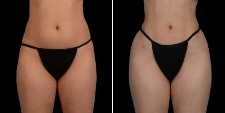 Liposuction Results Atlanta