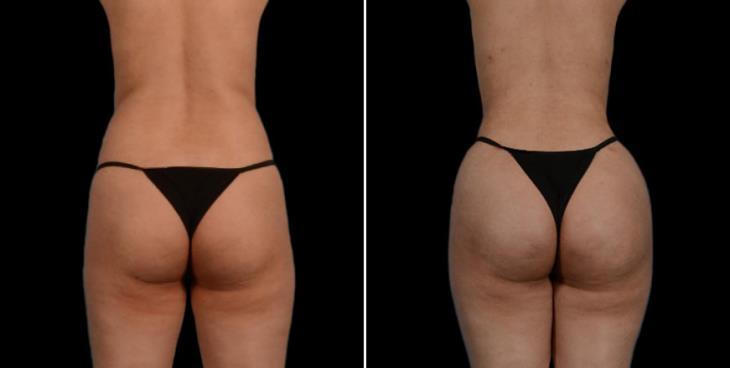 Liposuction Surgery Results Atlanta Back View