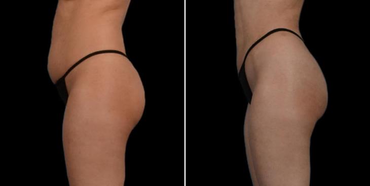 Liposuction Surgery Results Atlanta Left Side View