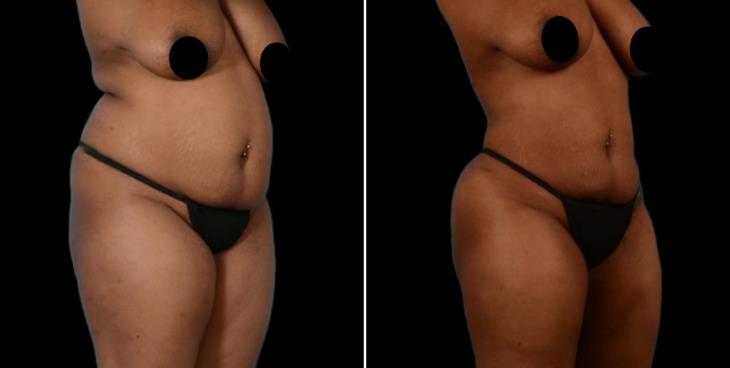 Atlanta Liposuction Before And After