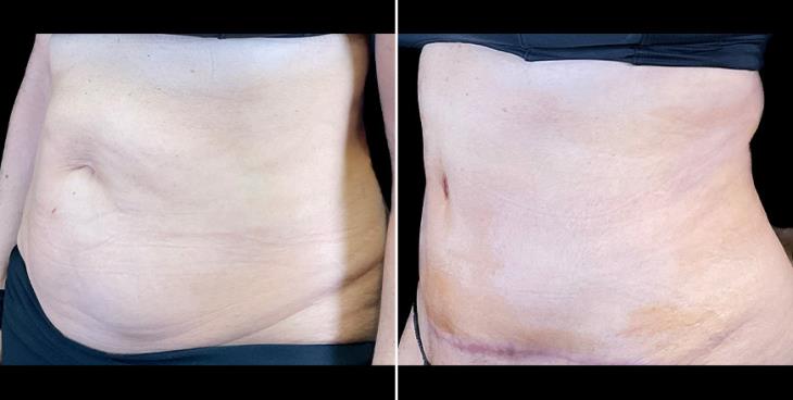 Before & After Tummy Tuck Surgery Alpharetta ¾ Left View