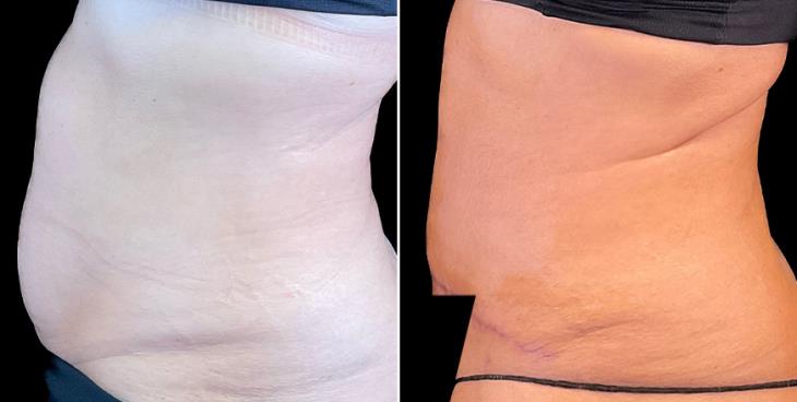 Before & After Tummy Tuck Surgery Alpharetta Left View
