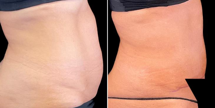 Before & After Tummy Tuck Surgery Alpharetta Right View