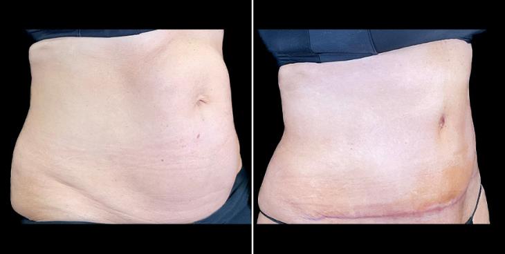 Before & After Tummy Tuck Surgery Alpharetta ¾ Right View