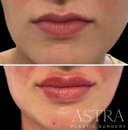 Lip Augmentation Results Atlanta GA