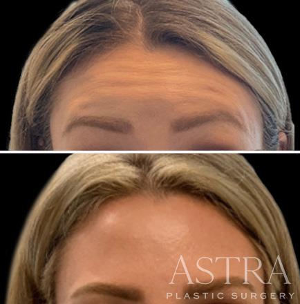 Results Of Botox Injections In Atlanta GA