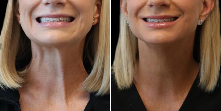 Results Of Botox On The Neck Atlanta