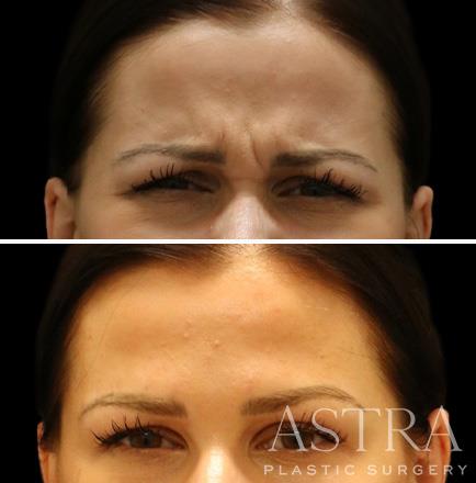 Botox Of The Forehead Results Atlanta GA