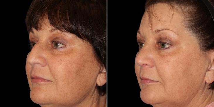 Alpharetta Rhinoplasty Surgery Results