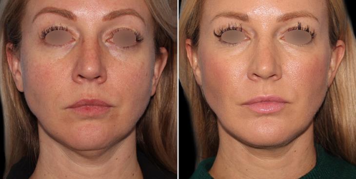 Chin Augmentation Results Atlanta Georgia