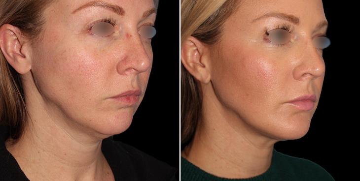 Chin Augmentation Results ¾ Right View
