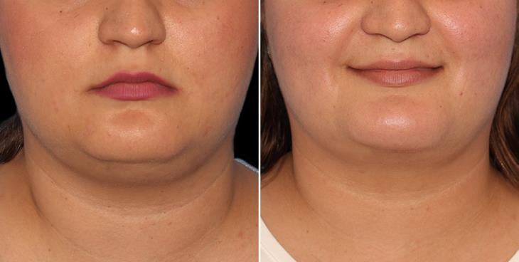 Atlanta Georgia Chin Augmentation Results