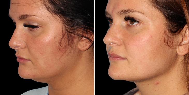 Before & After Facial Lipo ¾ Left View