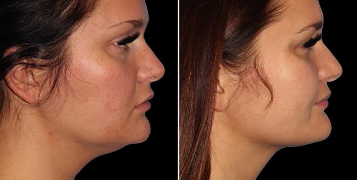 Before & After Facial Lipo Right Side View