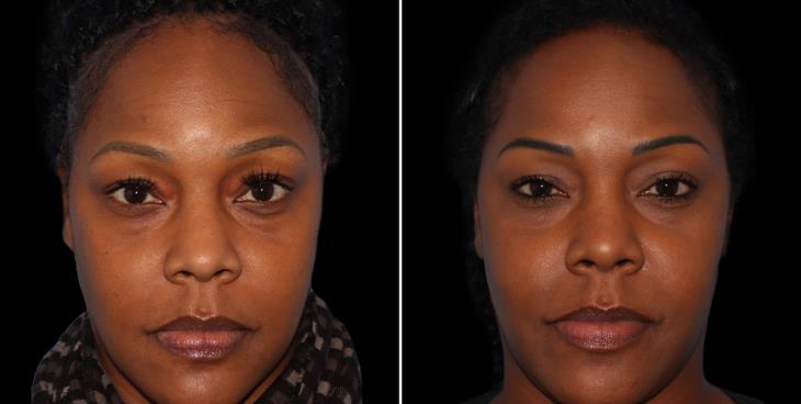 Forehead Reduction Results Atlanta
