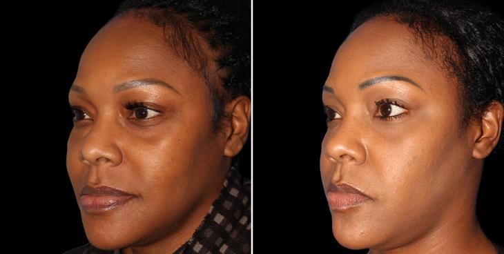 Forehead Reduction Before & After Atlanta ¾ Left View