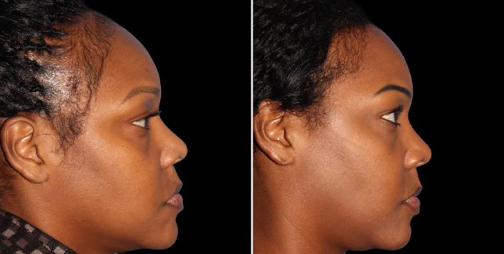 Forehead Reduction Before & After Atlanta Right Side View