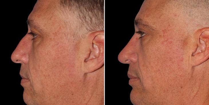 Rhinoplasty Before & After Alpharetta GA