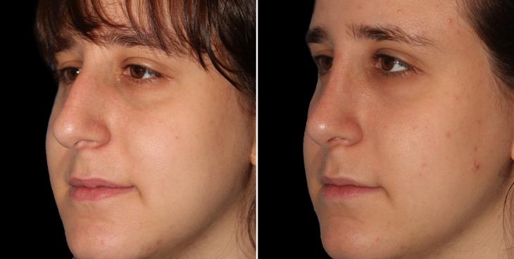 Rhinoplasty Surgery Before & After Alpharetta GA