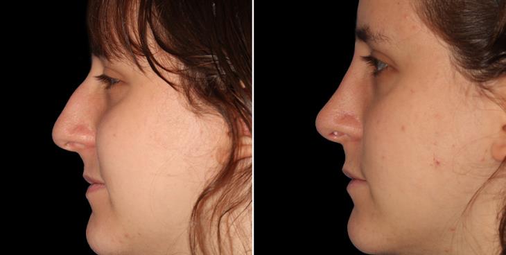 Rhinoplasty Surgery Before And After Alpharetta GA
